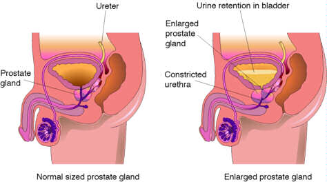 Must Read!! All The Education You Need About Prostrate Disease