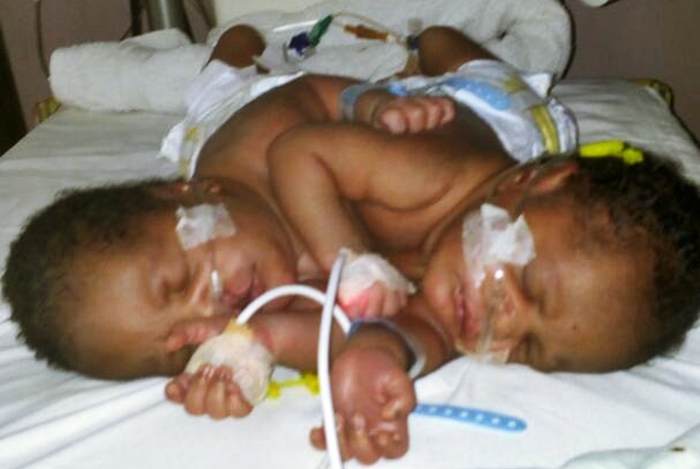 DELSUTH Delivers First Set Of Siamese Twins As Former Delta SSG Urges Nigerians To Fund Surgery